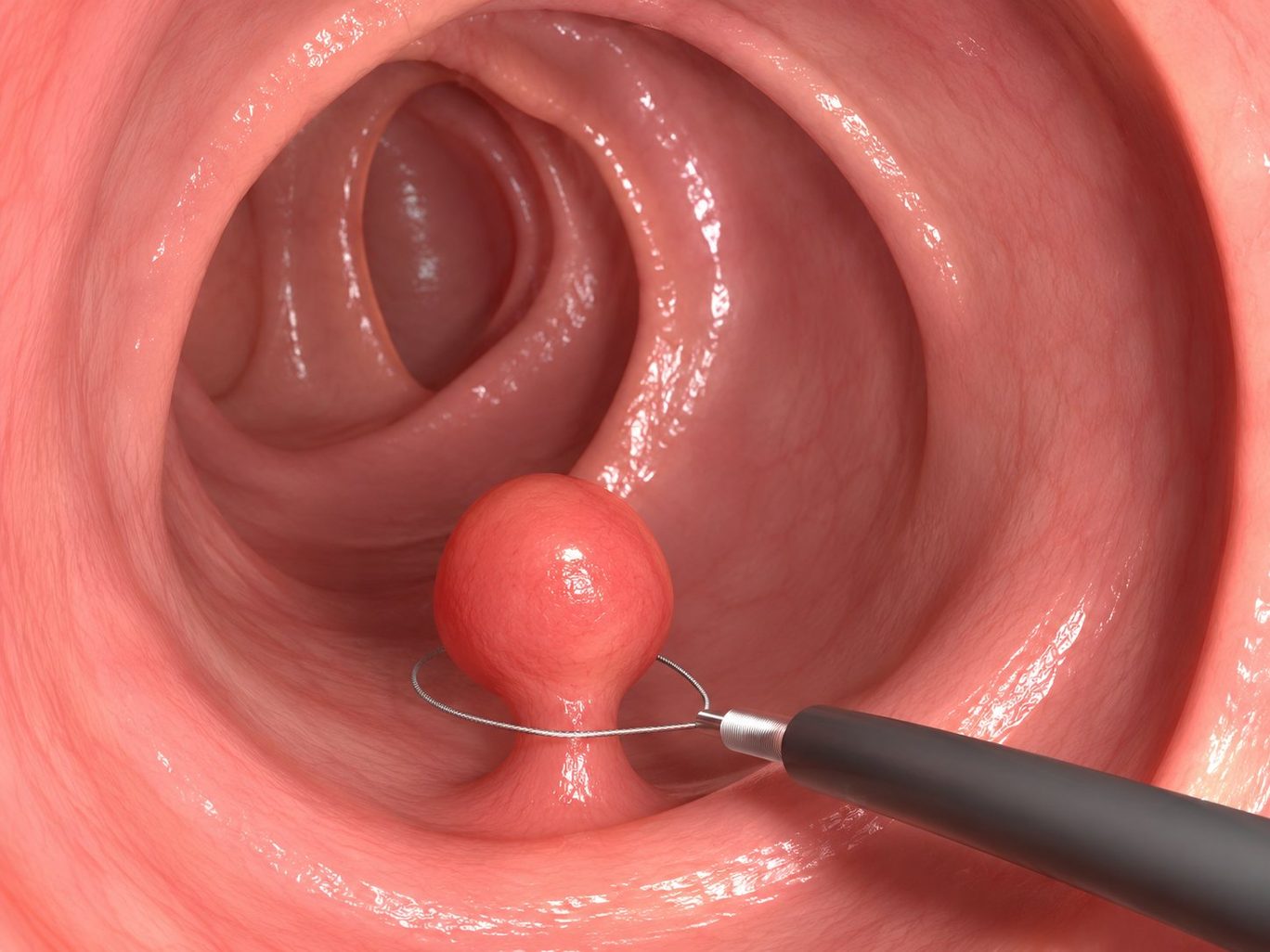 内視鏡のスネアで大腸ポリープの根元を締めて切除するイメージ